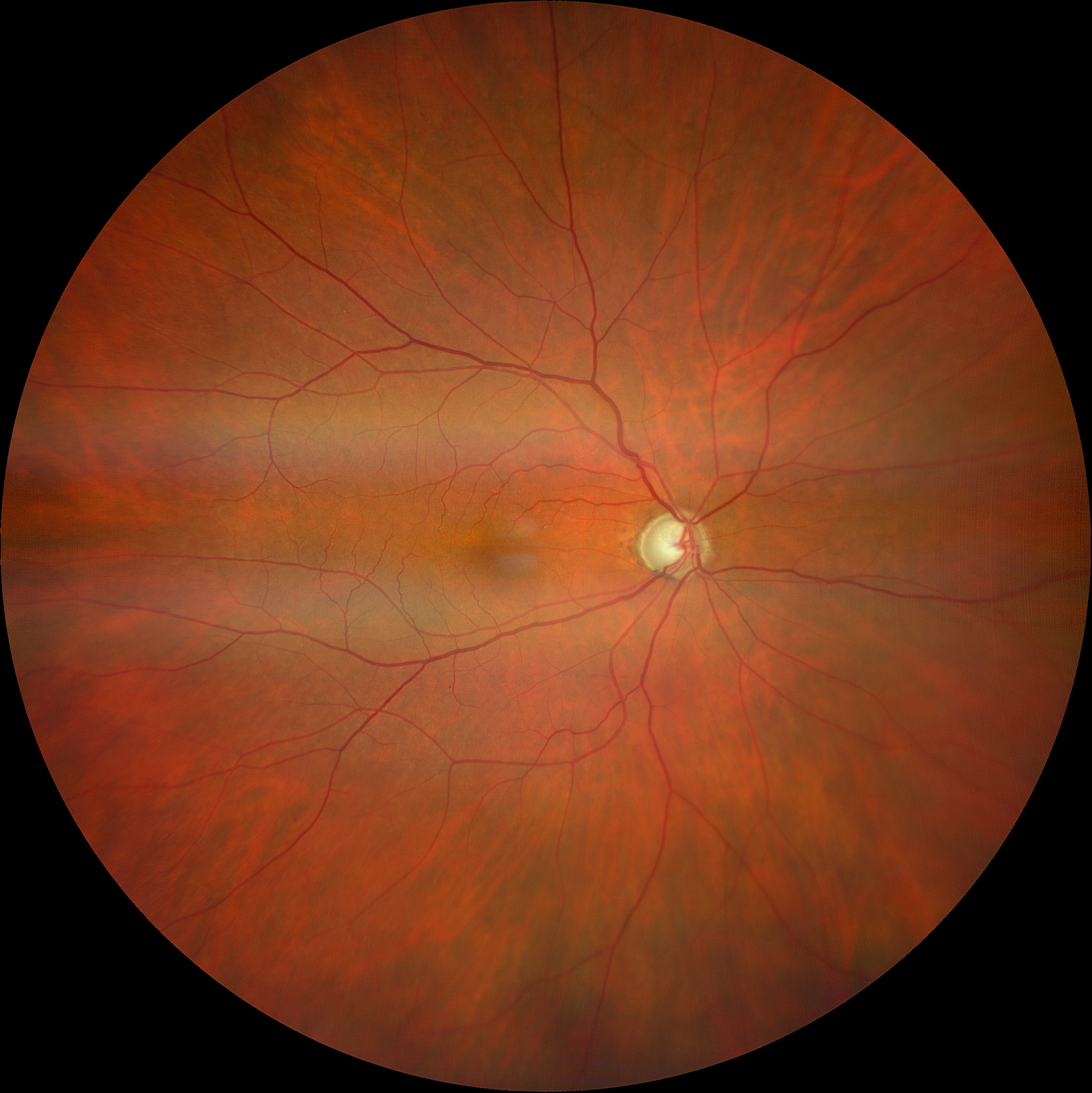 Nervo ottico glaucomatoso avanzato